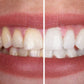 Whitening gel - For a radiant smile 
